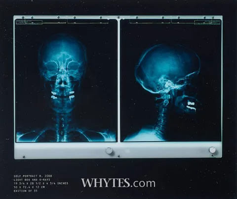 SELF PORTRAIT R. (LIGHT BOX AND X-RAYS) by Damien Hirst, 2008, photolithograph; (from an edition of 35); (framed with usb powered lightbox), sold Mar 2026