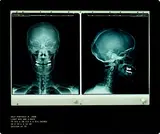 Damien Hirst British, Self-Portrait (X-Ray)
