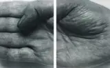 John Coplans, Hand, 1988, gelatin silver print mounted to board, diptych