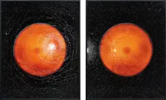 Self-portrait (with the help of optometrist) R and L from Retinal Shift by Mikhael Subotzky, 2012, Unique archival pigment diptych, face-mounted to toughened glass smashed by the artist, executed 2018, sold Nov 2018
