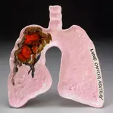 Rebecca Howland, Lung Cancer Ashtray, 1984, glazed ceramic