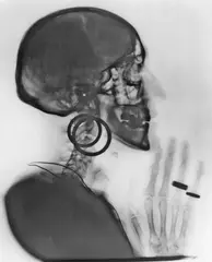 Meret Oppenheim, X-Ray, 1964, Silbergelatineabzug einer Röntgenphotographie, 1981
