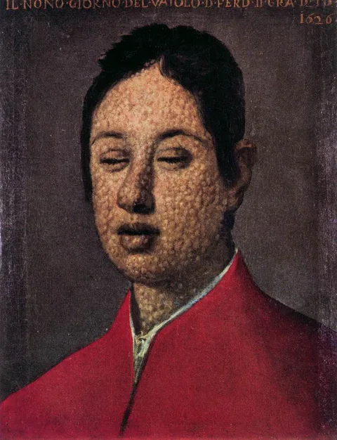 Justus Sustermans, Portrait of Ferdinando II on the ninth day of smallpox